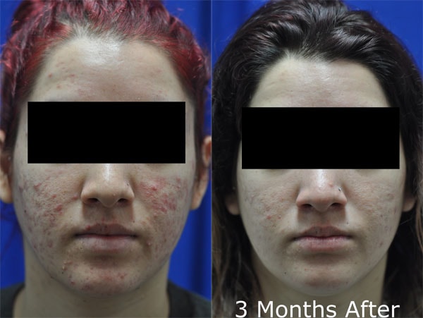 Acne treatment 3 months after — before and after front view
