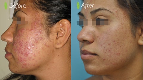Acne scar treatment before and after — side profile close-up