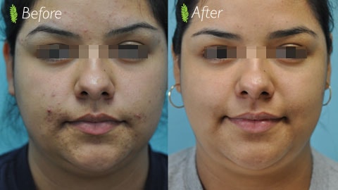 Acne scar treatment before and after — front view