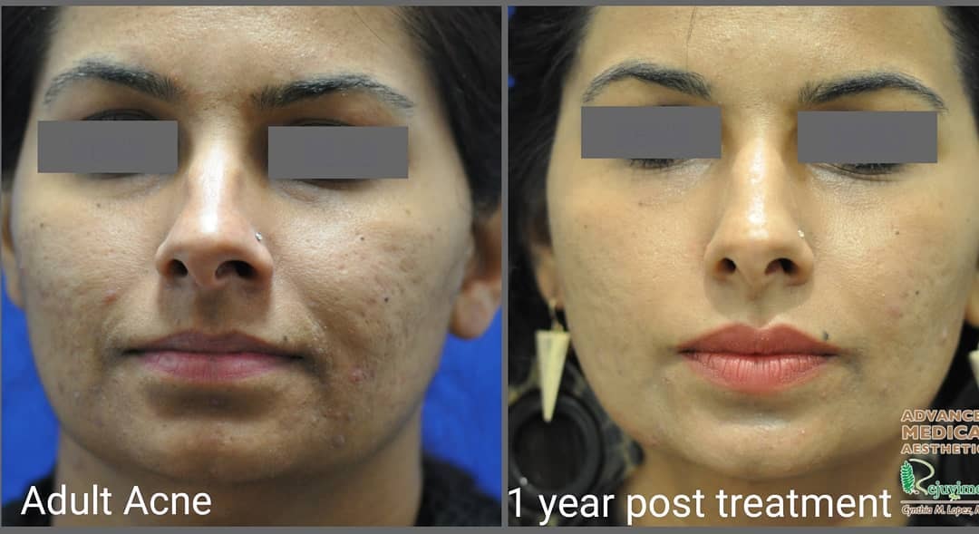 Adult acne — 1 year post treatment before and after