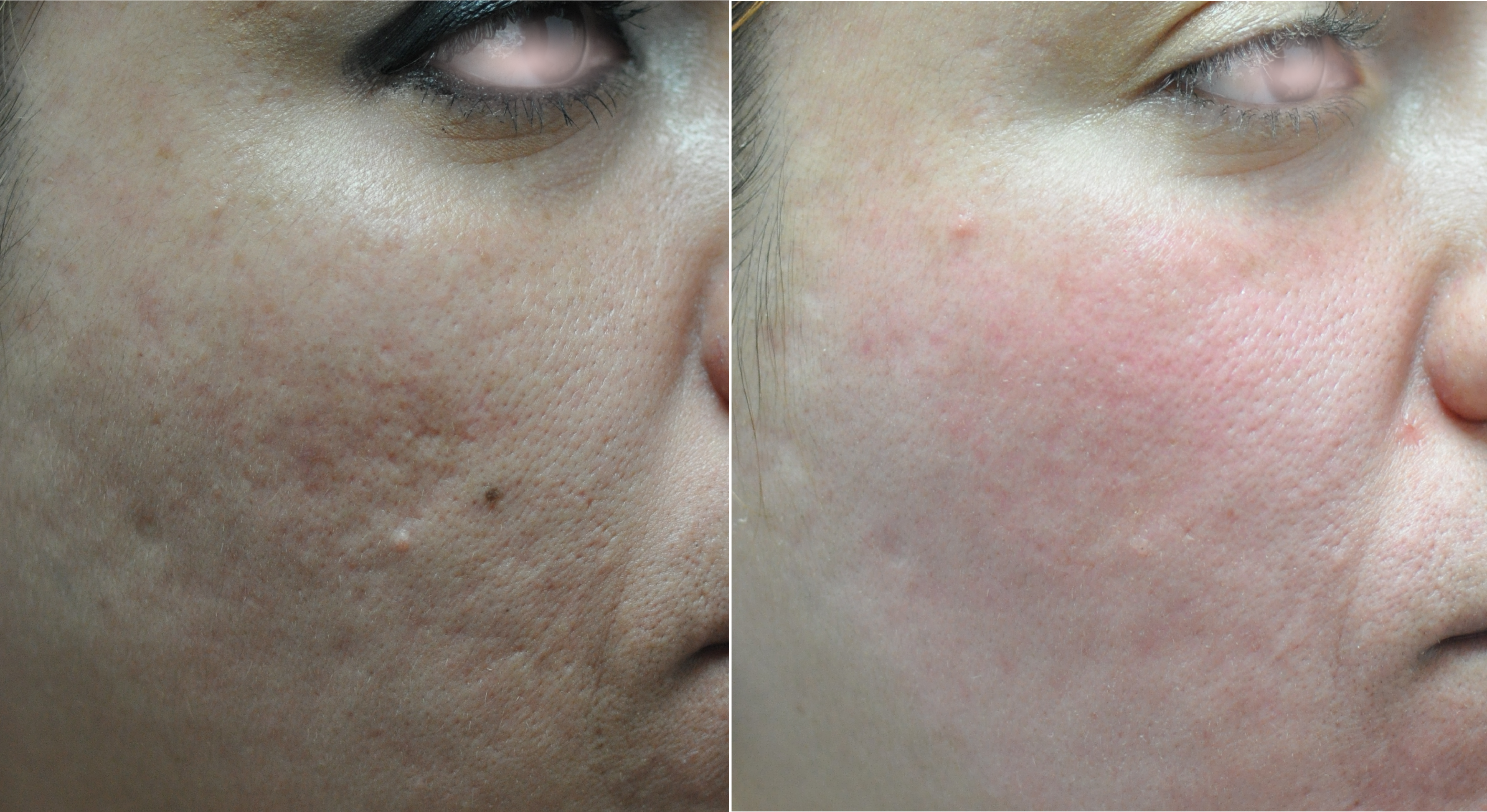 Acne scar before and after — side profile with visible improvement