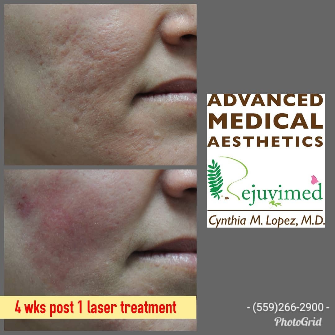 4 weeks post 1 laser treatment — acne scar cheek before and after