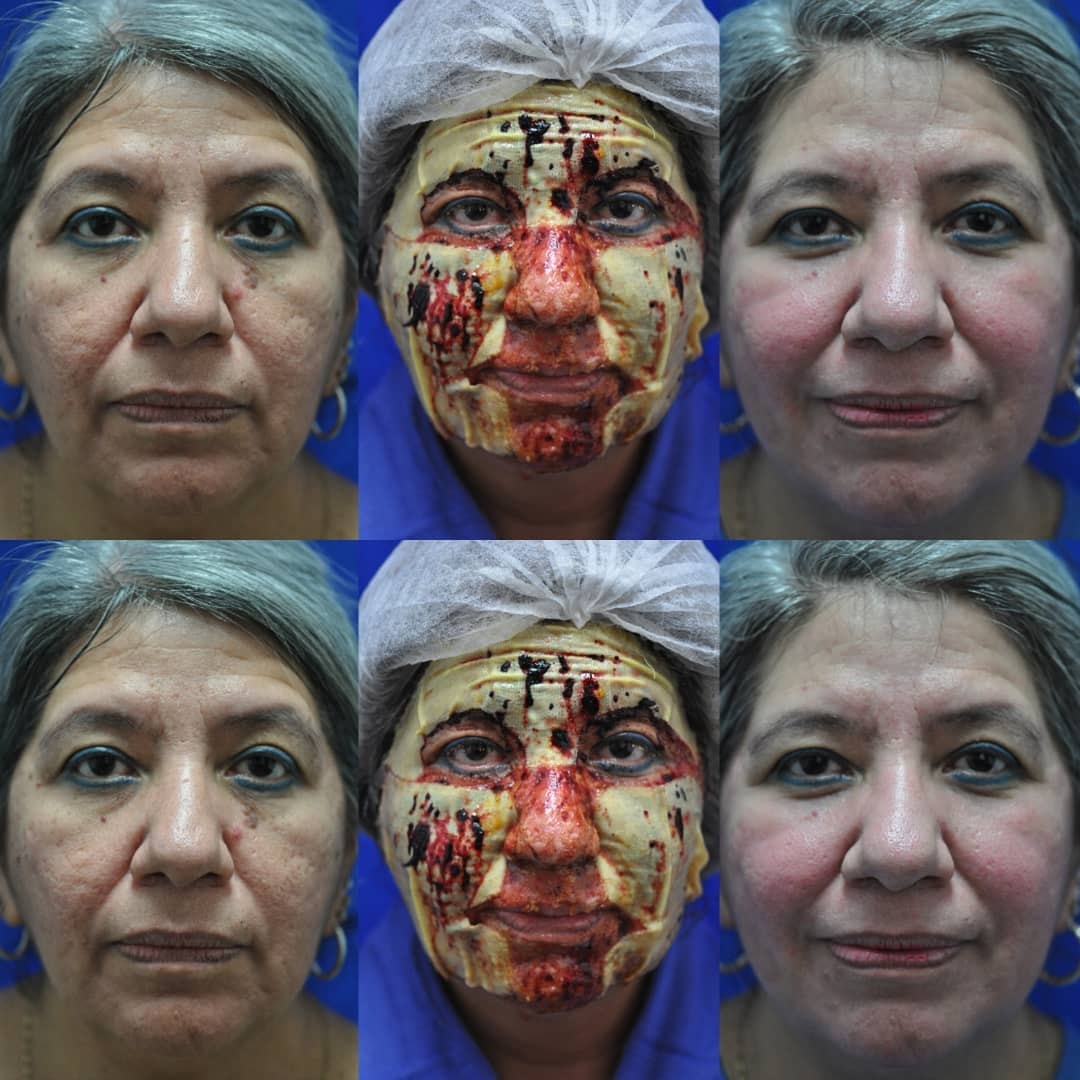 Full face laser resurfacing before, during, and after