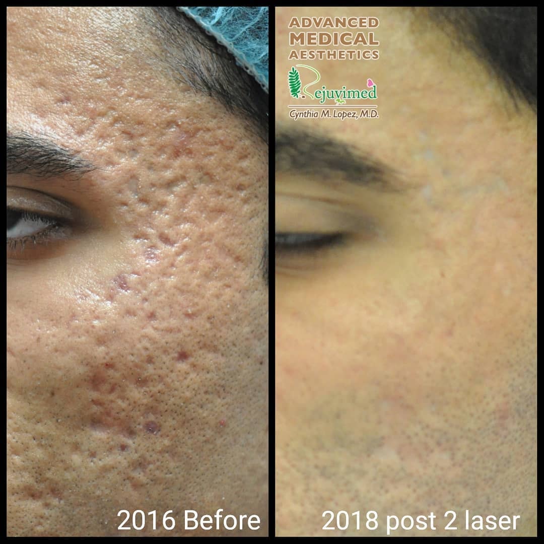 2016 Before / 2018 post 2 laser — acne scars slideshow