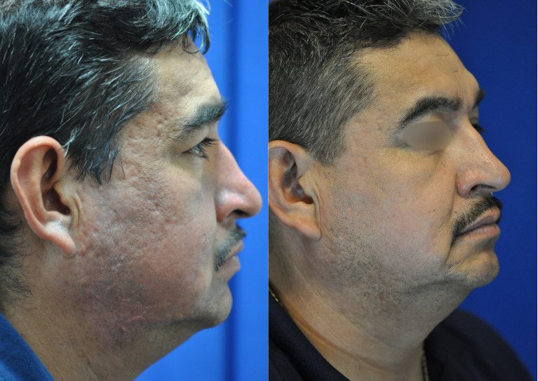 Before and after acne scar treatment results at Rejuvimed