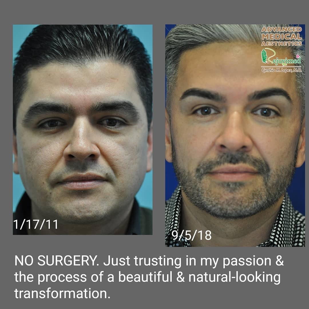 Patient before and after — laser resurfacing, dermal fillers, and Botox
