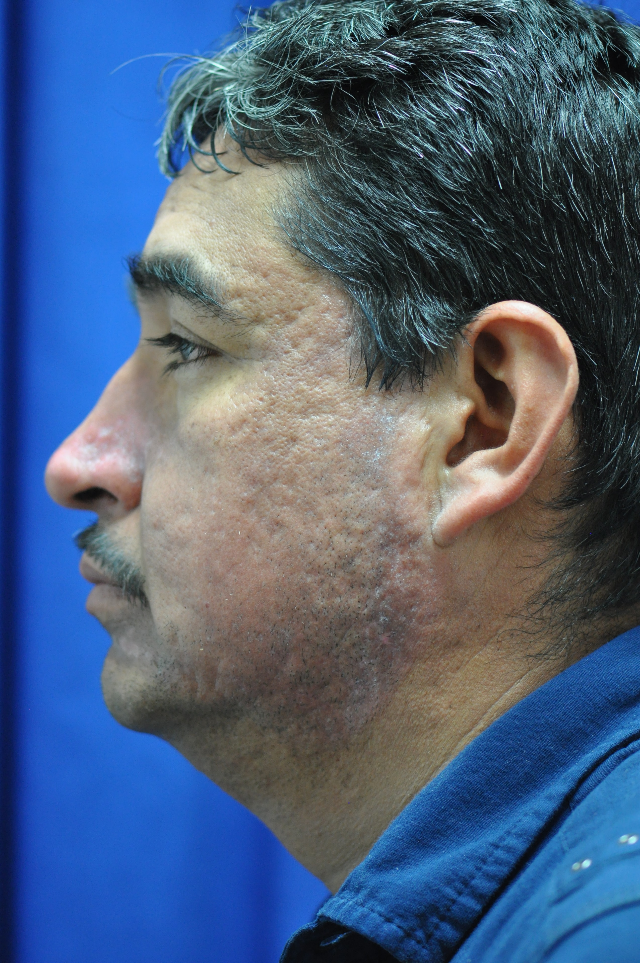 Manuel Rodriguez — acne scar treatment before and after, left profile sequence