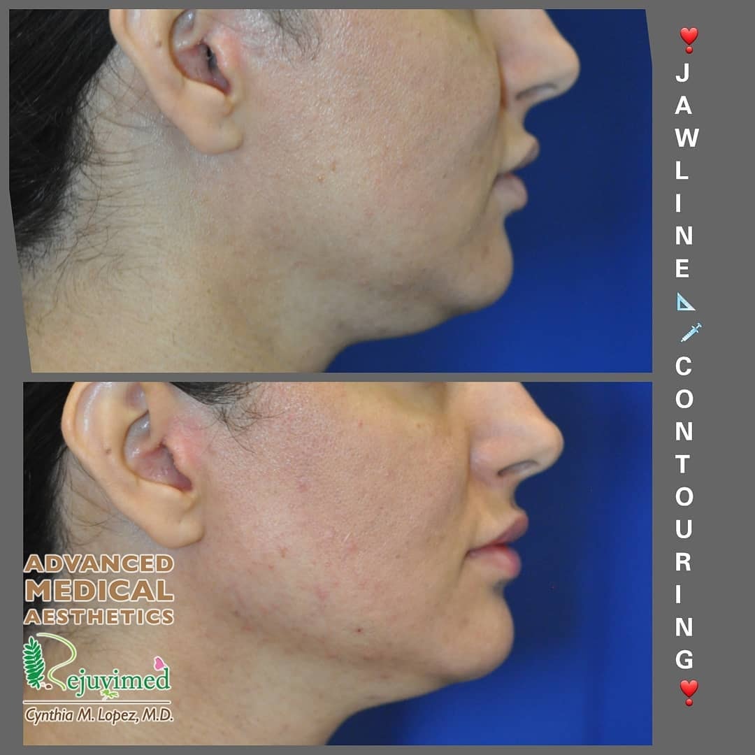 Jawline contouring before and after — side profile showing defined jawline result