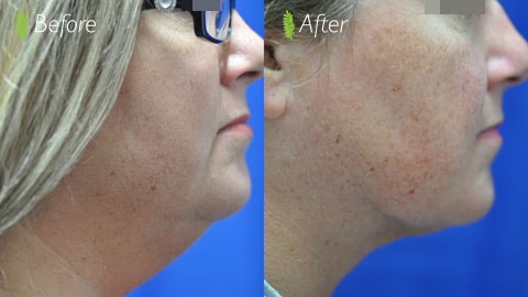 Double chin before and after — side profile left