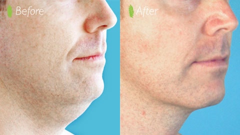 Double chin before and after — neck liposuction side profile