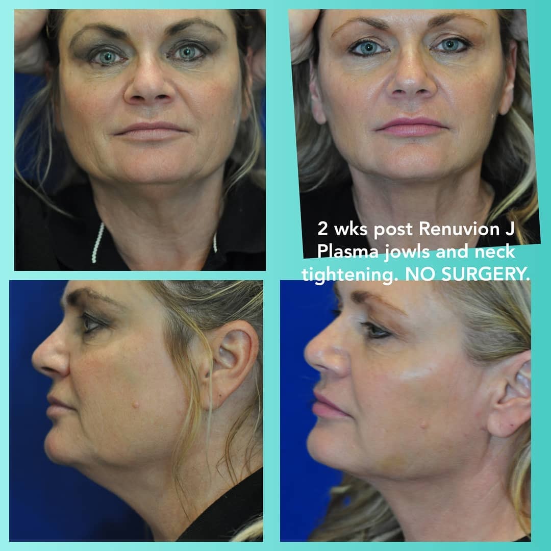 2 weeks post Renuvion J Plasma jowls and neck tightening — no surgery