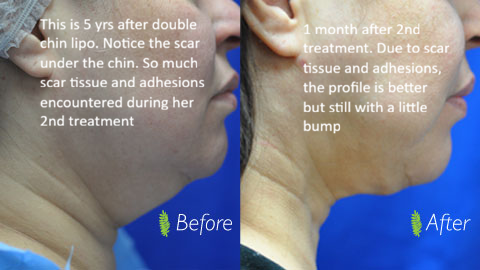 5 years after double chin lipo — before and after 2nd treatment showing scar tissue and adhesions