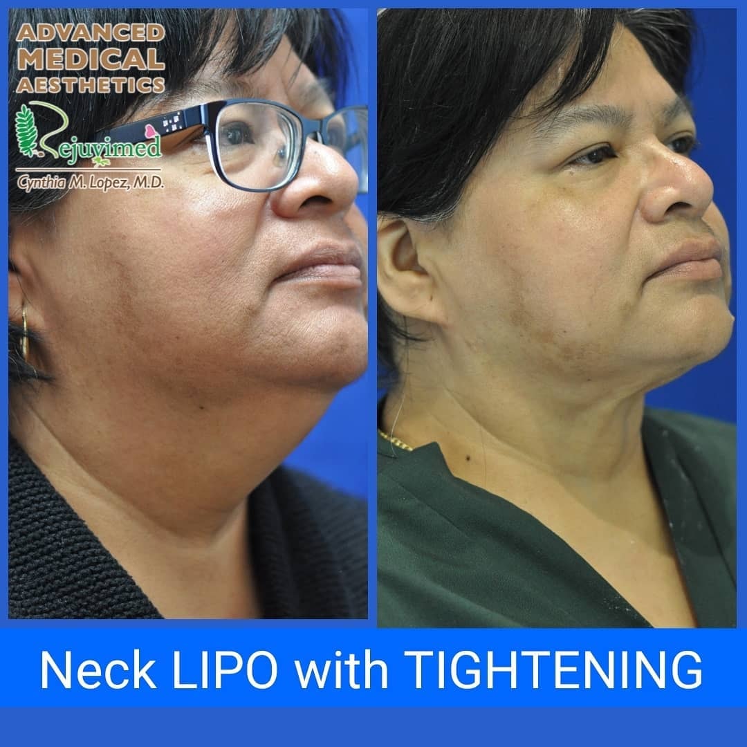 Neck lipo with tightening — three-quarter view before and after