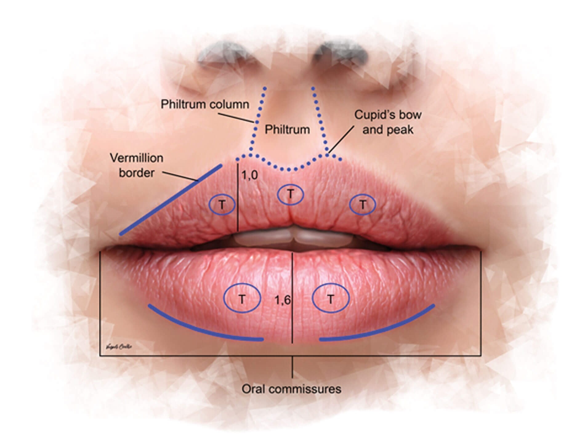 Anatomical diagram of lip subunits — philtrum column, Cupid's bow, vermillion border, oral commissures — used to guide precise filler placement