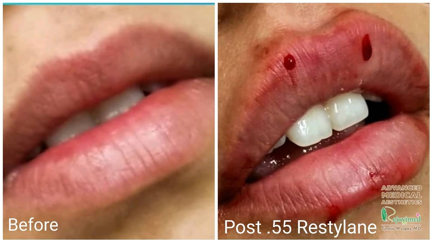 Lip filler before and after – post 0.55cc Restylane