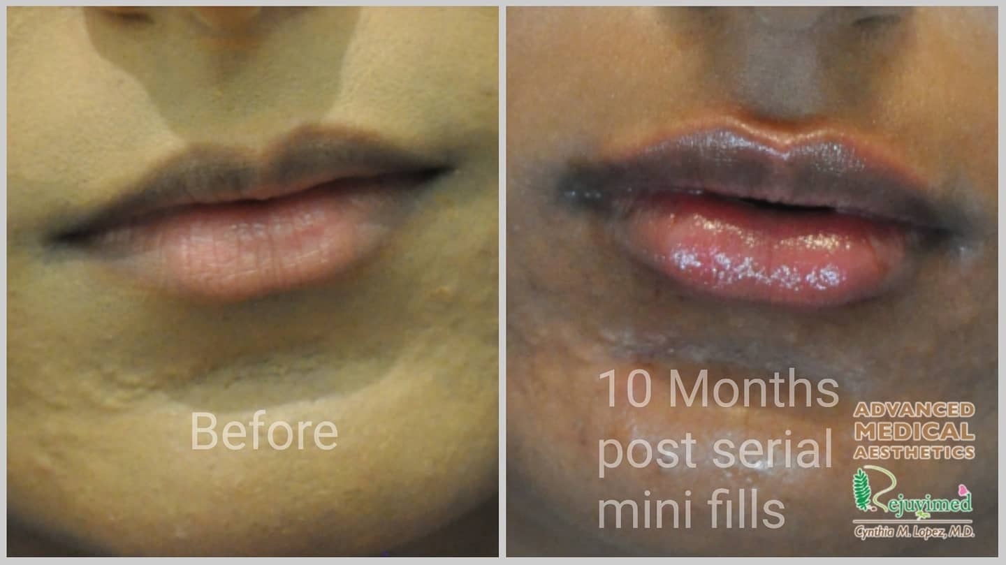 Lip filler before and after – 10 months post serial mini fills