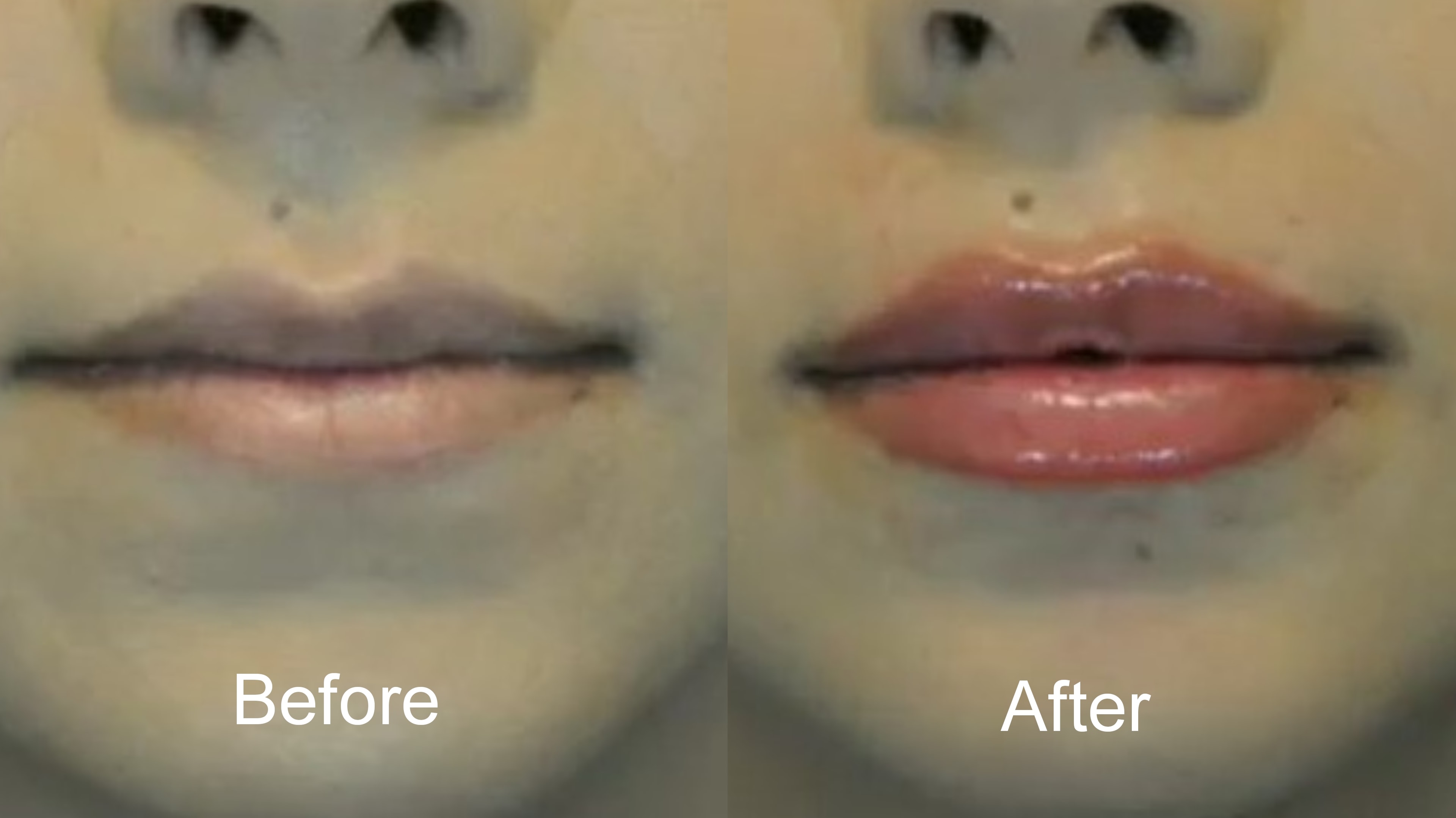 Lip filler before and after – natural subtle enhancement by Dr. Lopez