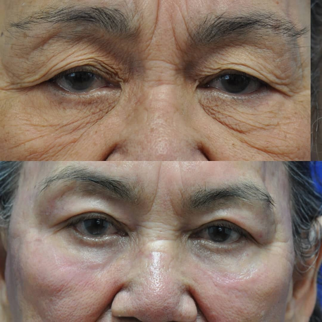 Female patient before and after CO2 laser resurfacing — hooded eyelids lifted and festoons removed