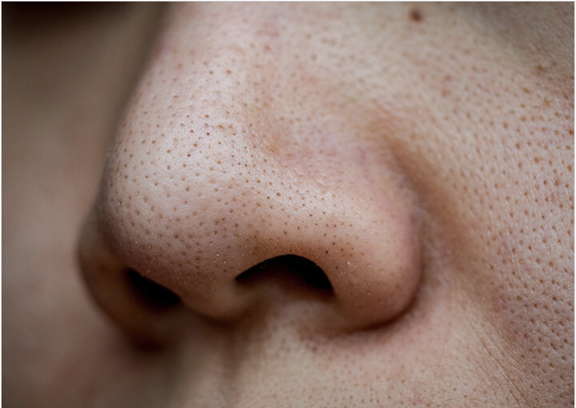 Close-up of skin showing large pores on the nose
