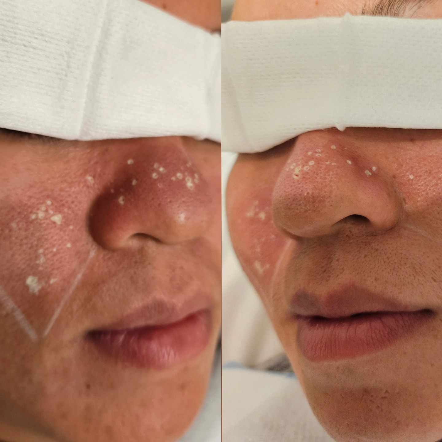 Before and after TCA CROSS — nose ice pick scars post treatment