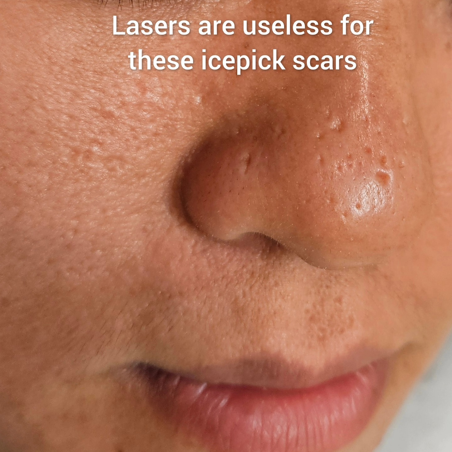Ice pick scars on nose — lasers are useless for these, TCA CROSS is the solution