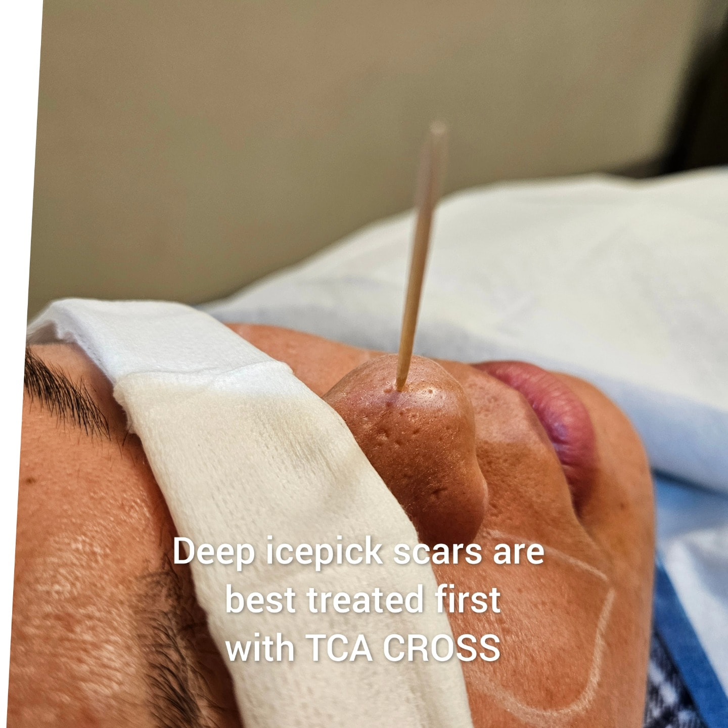 TCA CROSS procedure being performed on deep ice pick scars with toothpick applicator