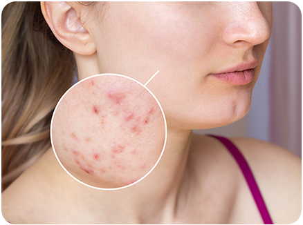 Woman with acne scars on her face
