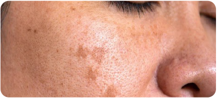 Closeup of a woman with melanin on her face