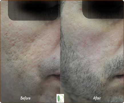 The contrast between the before and after photos highlights the remarkable difference in the man's complexion following treatment.