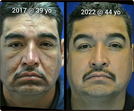 The change in the man's skin from before to after acne treatment is truly remarkable, showcasing a newfound clarity and smoothness.