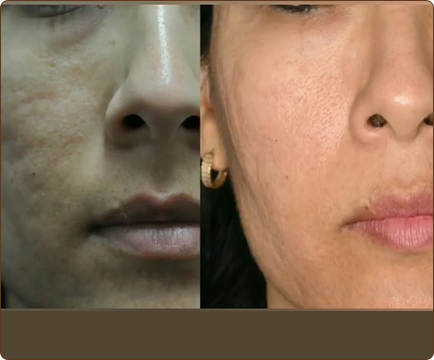 The progression from the initial image of acne scars to the subsequent image of clear and rejuvenated skin emphasizes the effectiveness of acne treatment.