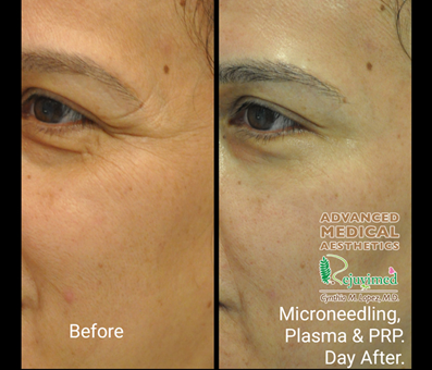 woman looks young and beautiful after microneedling plasma and PRP treatment.