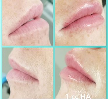 1cc HA lip treatment
