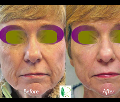 Before the youth treatment, the woman's face displayed wrinkles and signs of aging, which have been significantly reduced in the after image.