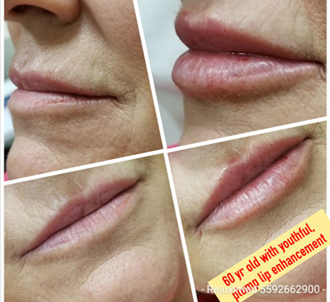 60 year old woman with youthful, plump lip enhancement from rejuvimed.
