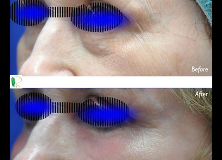 The side-by-side comparison of the before and after images underscores the remarkable effects of eye treatment on the woman's overall look