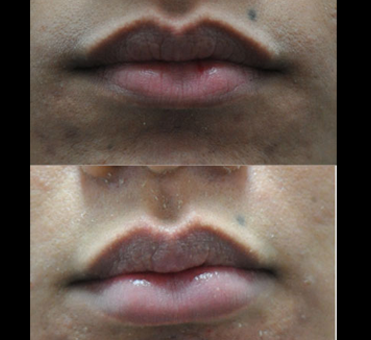 Lip treatment has visibly enhanced the woman's lip fullness and definition, as evident in the side-by-side comparison of the two images.