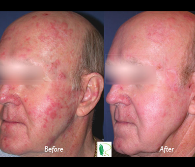 treatment from rejuvimed has visibly transformed the man's facial appearance, as evident in the side-by-side comparison of the 