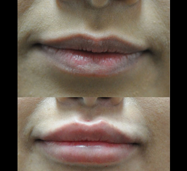 The difference in the woman's lip appearance before and after lip treatment is evident, with fuller and more defined lips in the after image.