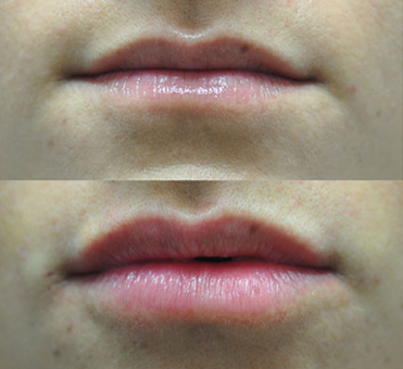 The before and after images offer a compelling visual representation of the transformative impact of lip treatment on the woman's lip appearance.