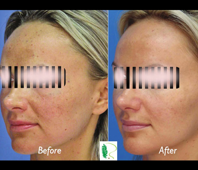 In the initial photo, the woman's face displayed signs of aging, including wrinkles, but in the second image, the results of the youth treatment are strikingly clear.