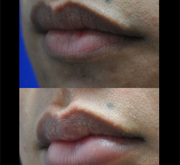 Before the lip treatment, the woman's lips lacked volume, but the after image showcases a significant improvement in the lips appearance.