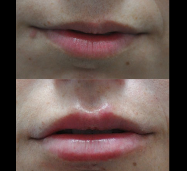 In the initial photo, the woman's lips appeared thin, but in the second image, the results of the lip treatment are strikingly clear.