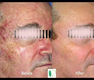 The before and after images offer a compelling visual representation of the transformative impact of treatment on the man's face.