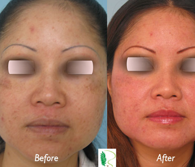 The difference in the woman's facial appearance before and after youth treatment is evident, with a more youthful, radiant, and refreshed look in the after image.