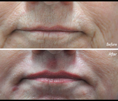 The before photo highlights concerns related to aging and wrinkles, while the after picture shows successful results of treatment.