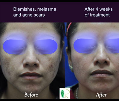 Before and after treatment of blemishes, melasma and acne scars