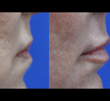 Before the lip treatment, the woman's lips appeared thinner, which has been significantly improved in the after image.