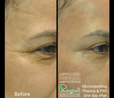comparison of two images before and after microneedling plasma and PRP treatment.