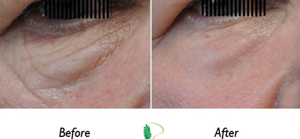 Eye treatment has visibly transformed the woman's eye area, as evident in the side-by-side comparison of the before and after photos